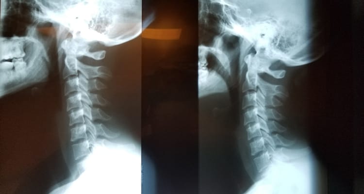 Neck curve before and after